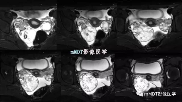 【PPT】原发性卵巢蒂扭转影像诊断
