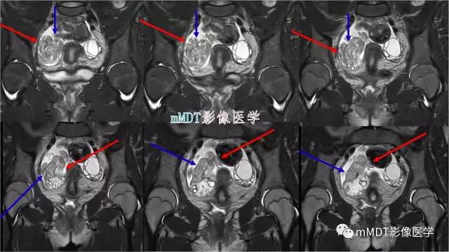 【PPT】原发性卵巢蒂扭转影像诊断