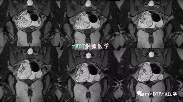 【PPT】原发性卵巢蒂扭转影像诊断