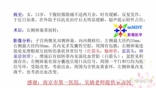 【PPT】原发性卵巢蒂扭转影像诊断
