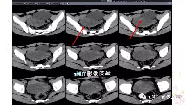 【PPT】原发性卵巢蒂扭转影像诊断