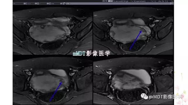 【PPT】原发性卵巢蒂扭转影像诊断
