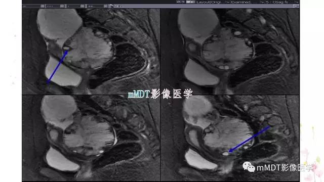 【PPT】原发性卵巢蒂扭转影像诊断