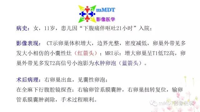 【PPT】原发性卵巢蒂扭转影像诊断