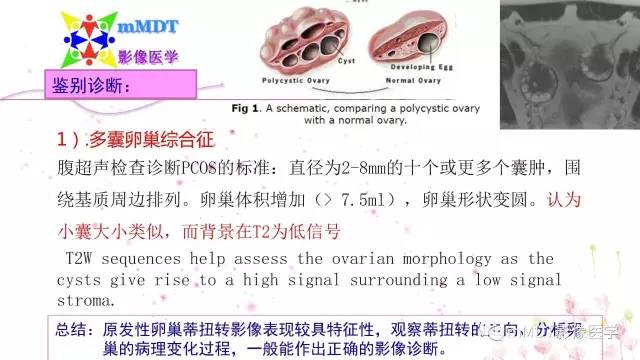 【PPT】原发性卵巢蒂扭转影像诊断
