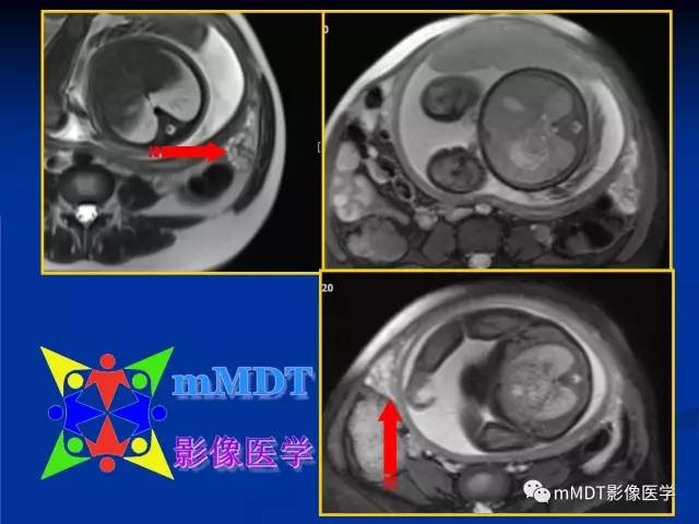 【PPT】女性附件扭转MRI的表现