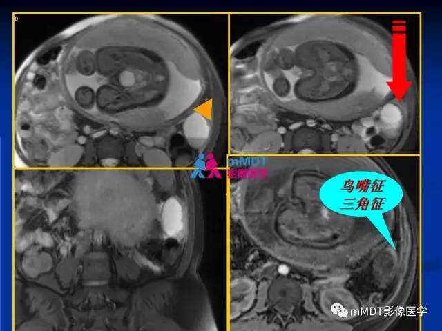 【PPT】女性附件扭转MRI的表现