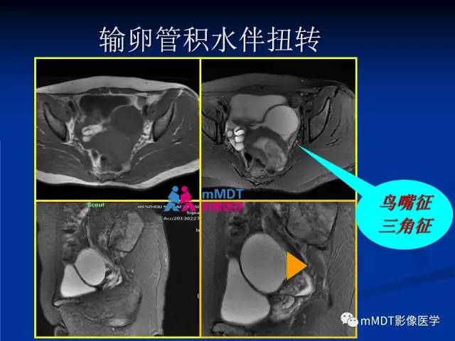 【PPT】女性附件扭转MRI的表现