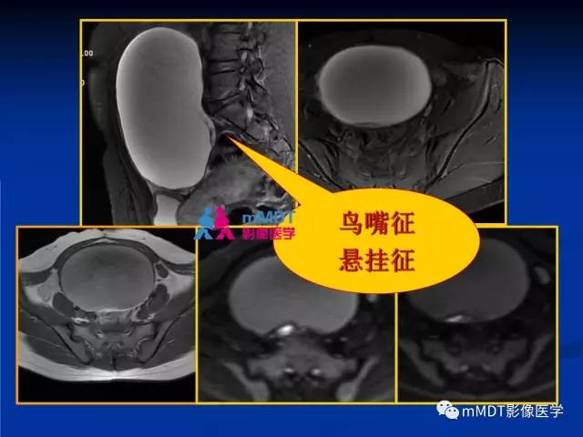 【PPT】女性附件扭转MRI的表现