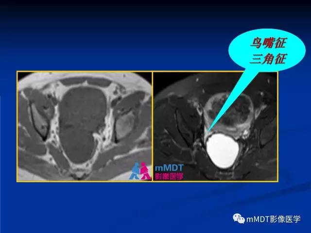 【PPT】女性附件扭转MRI的表现