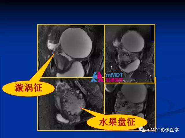 【PPT】女性附件扭转MRI的表现