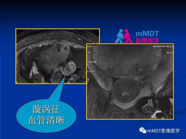 【PPT】女性附件扭转MRI的表现