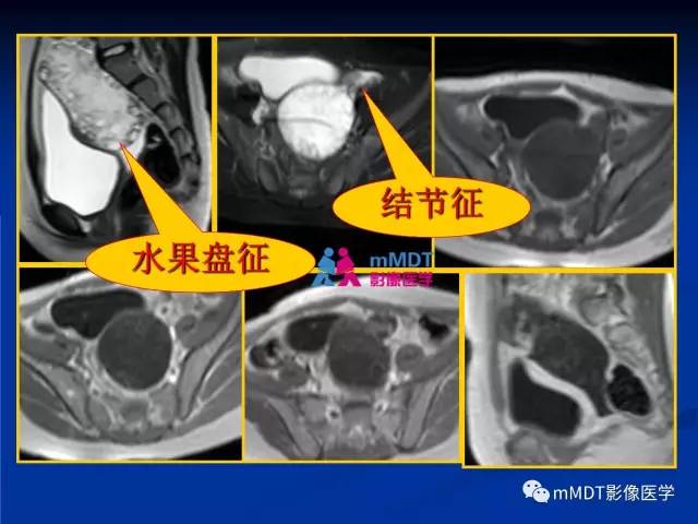 【PPT】女性附件扭转MRI的表现