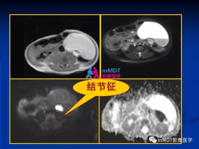 【PPT】女性附件扭转MRI的表现