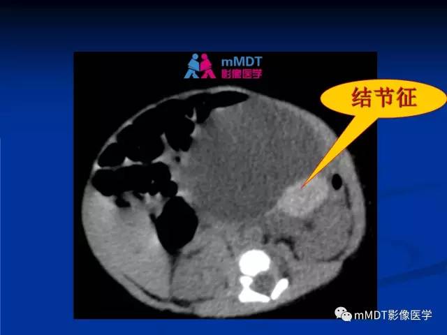 【PPT】女性附件扭转MRI的表现