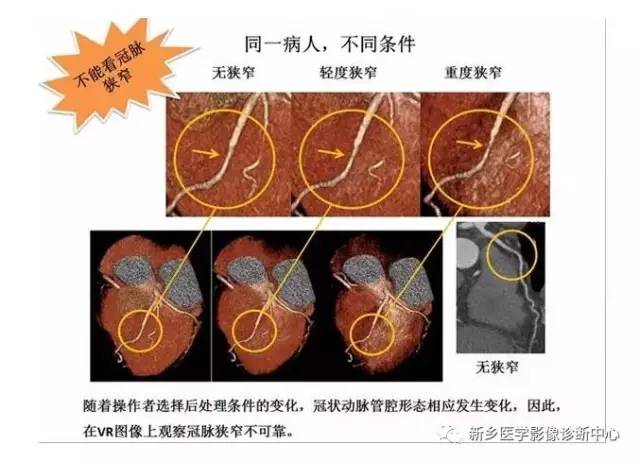 教你轻松学看冠脉CTA