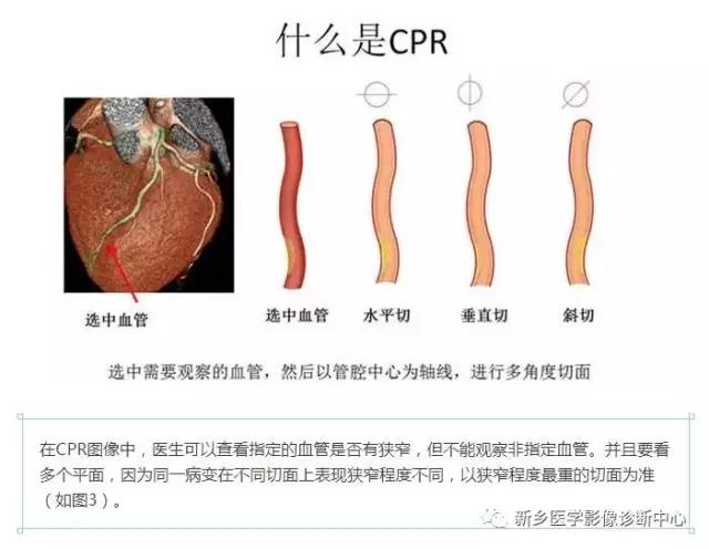 教你轻松学看冠脉CTA