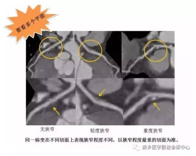 教你轻松学看冠脉CTA