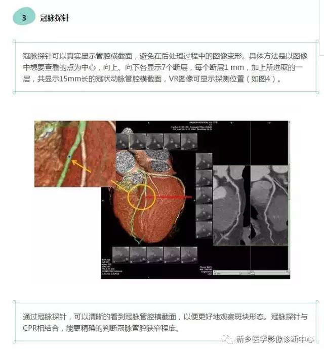 教你轻松学看冠脉CTA