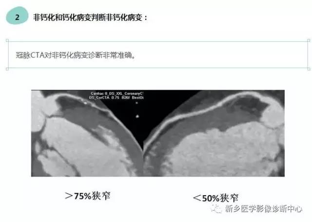 教你轻松学看冠脉CTA