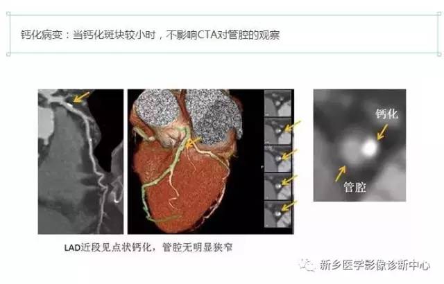 教你轻松学看冠脉CTA