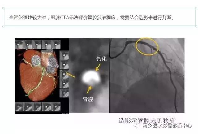 教你轻松学看冠脉CTA