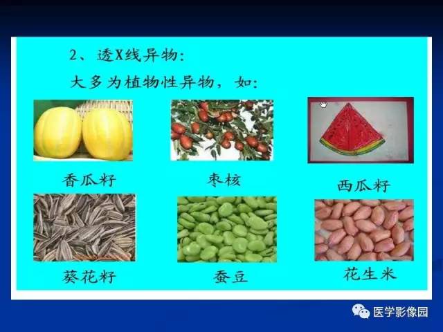 【PPT】儿童气管及支气管非金属异物影像学评价