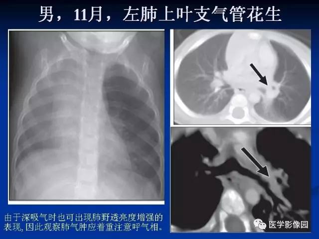 【PPT】儿童气管及支气管非金属异物影像学评价