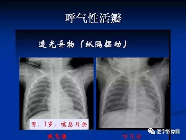 【PPT】儿童气管及支气管非金属异物影像学评价