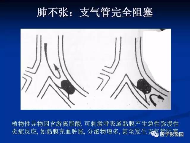 【PPT】儿童气管及支气管非金属异物影像学评价