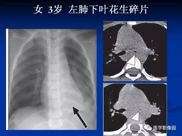 【PPT】儿童气管及支气管非金属异物影像学评价