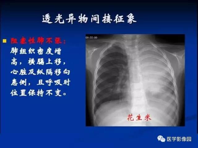 【PPT】儿童气管及支气管非金属异物影像学评价