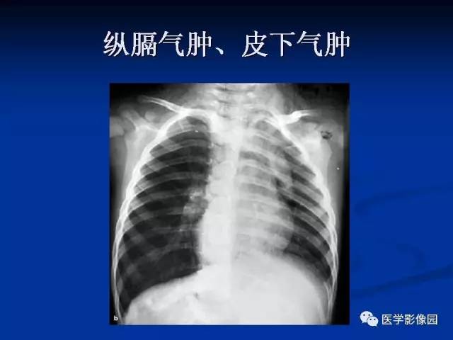 【PPT】儿童气管及支气管非金属异物影像学评价