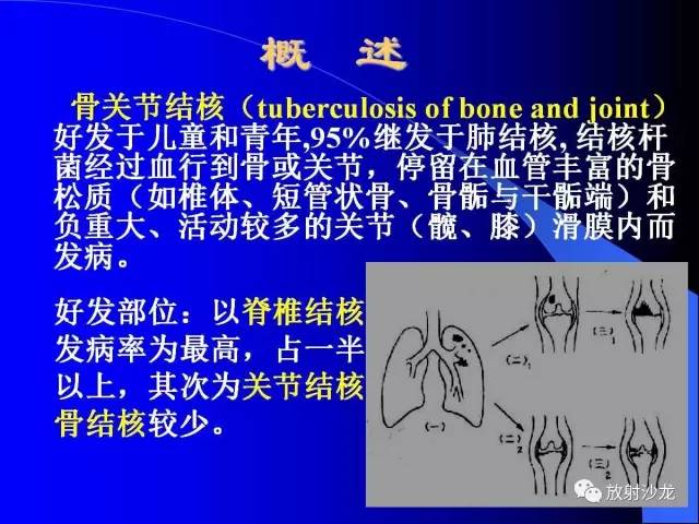 【PPT】脊柱结核影像学表现
