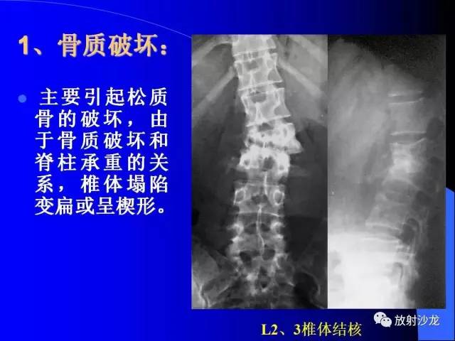 【PPT】脊柱结核影像学表现