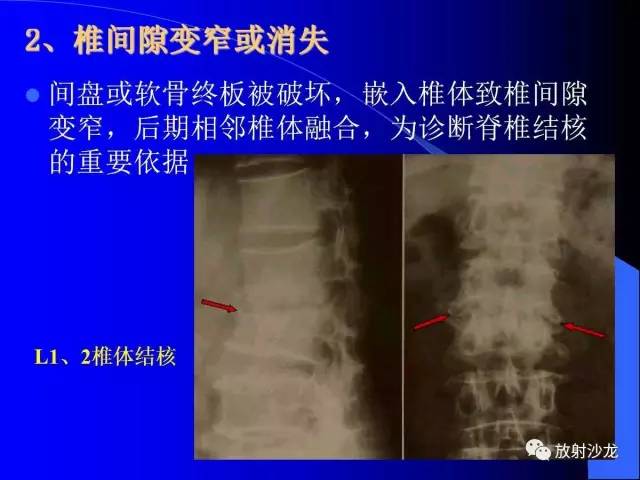 【PPT】脊柱结核影像学表现