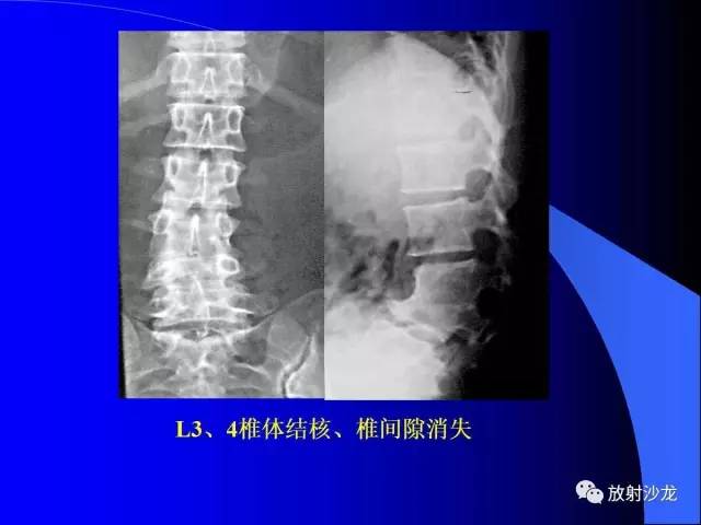 【PPT】脊柱结核影像学表现