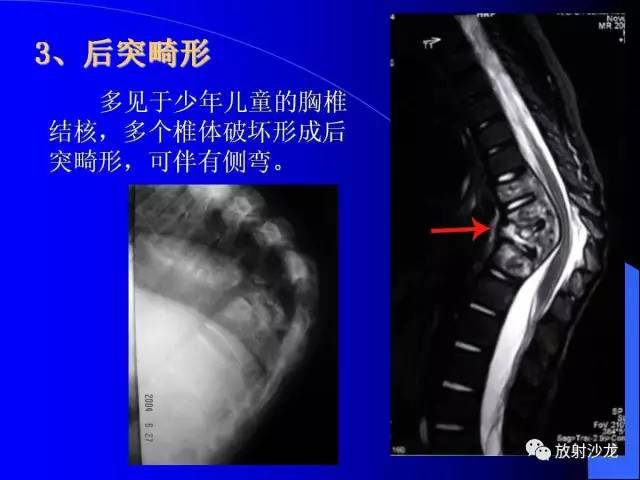 【PPT】脊柱结核影像学表现