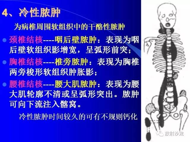 【PPT】脊柱结核影像学表现