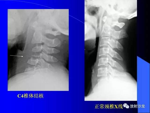 【PPT】脊柱结核影像学表现