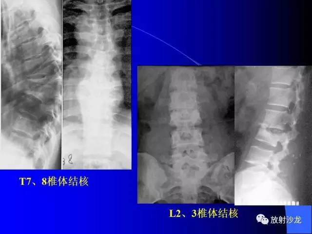 【PPT】脊柱结核影像学表现