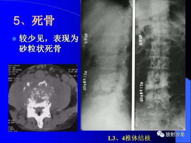 【PPT】脊柱结核影像学表现