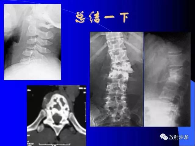 【PPT】脊柱结核影像学表现