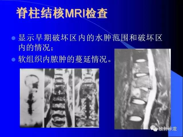 【PPT】脊柱结核影像学表现