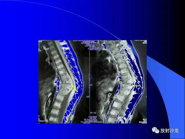 【PPT】脊柱结核影像学表现