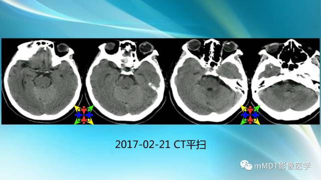 【PPT】副肿瘤神经综合征：小脑变性