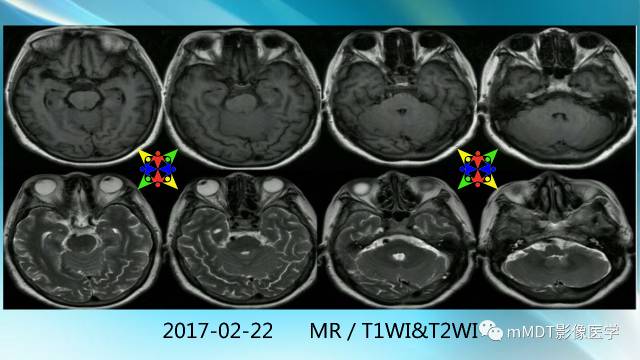 【PPT】副肿瘤神经综合征：小脑变性