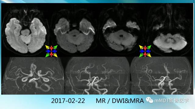 【PPT】副肿瘤神经综合征：小脑变性