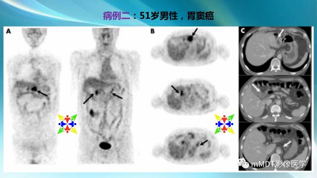 【PPT】副肿瘤神经综合征：小脑变性
