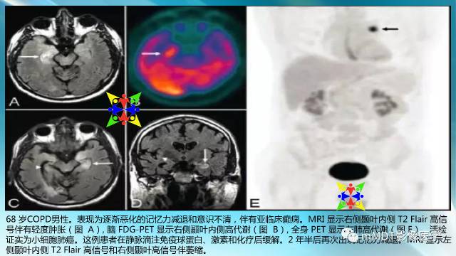 【PPT】副肿瘤神经综合征：小脑变性